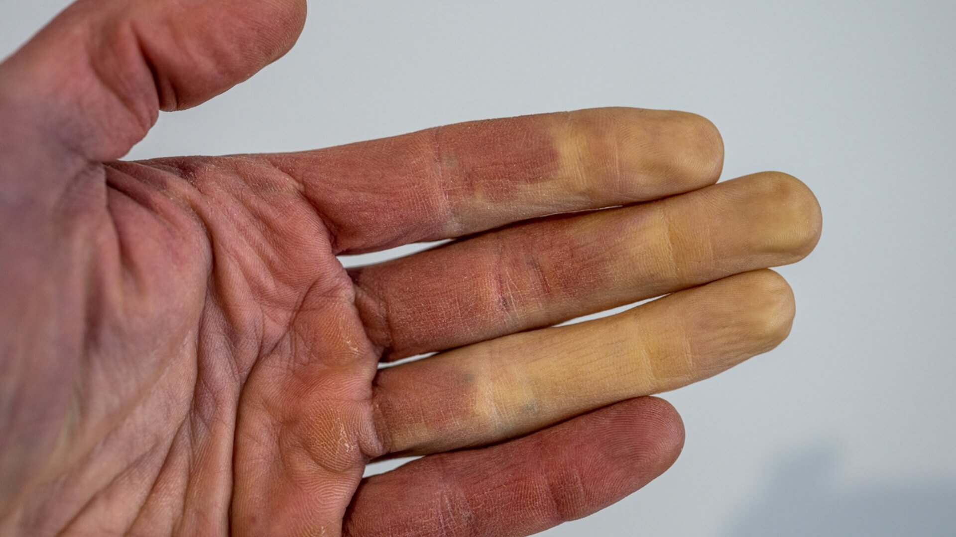 Early Warning Signs and Emergency Treatment for Hypothermia | AED Total Solution