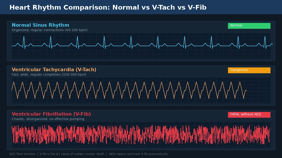 Heart rhythm comparison diagram showing normal sinus rhythm vs ventricular tachycardia vs ventricular fibrillation ECG patterns